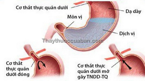 Co thắt thực quản