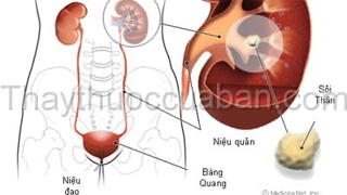 Cơn đau quặn thận