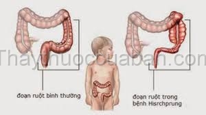 Giãn đại tràng ở trẻ em