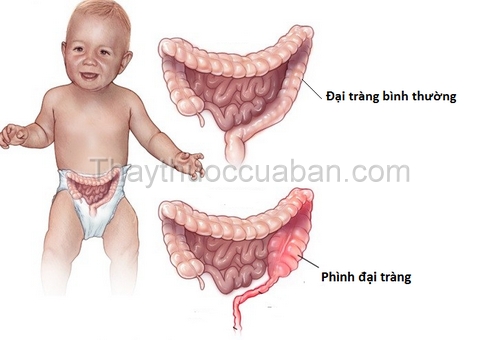 Giãn đại tràng ở trẻ em