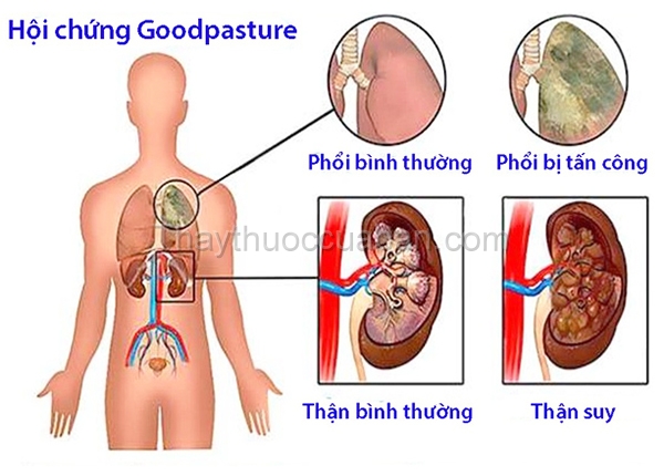 Hội chứng phổi thận