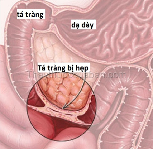 Tắc tá tràng ở trẻ em