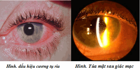 Cương tụ rìa và tủa sau giác mạc